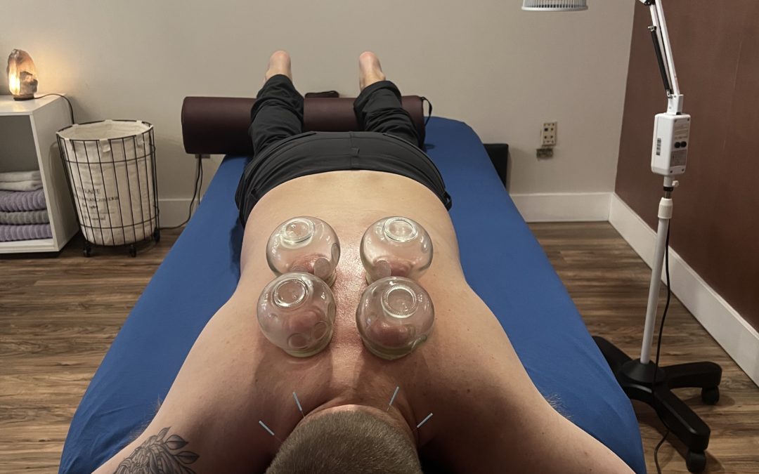 BENEFITS AND HEALING POTENTIAL OF CUPPING
